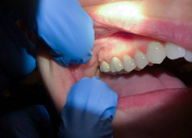 Best Knocked-Out Tooth (Avulsed Tooth) Treatment in Custer, SD